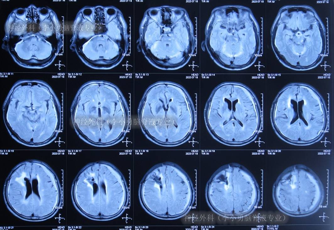 图-26:2023年7月18日颅脑核磁图-27:2023年8月2日颅脑ct脑脊液各项