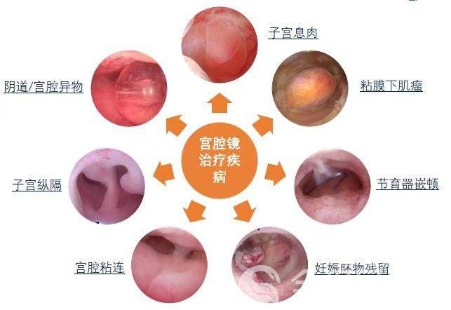 宫腔镜下正常宫腔图片图片