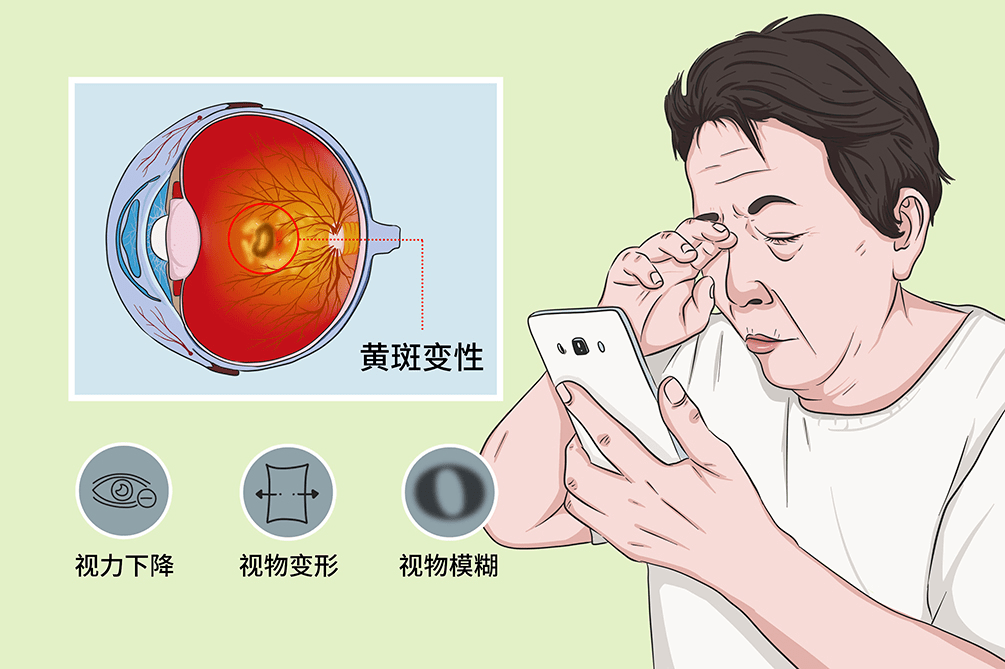 创新眼科双靶点药物ibi302正在招募中!_视网膜_研究人员_mg