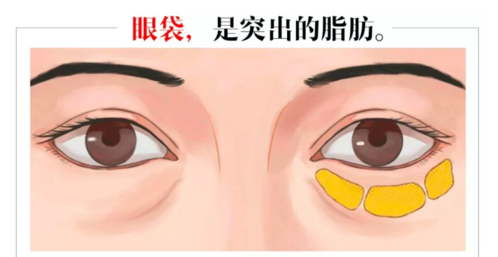 辽宁杏林:祛眼袋哪种方法好?_脂肪_皮肤_下眼睑