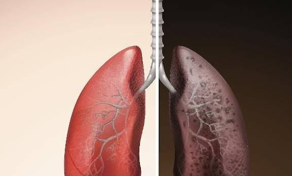 成功戒烟后,肺部还能恢复正常吗?或许看完后你就知道了!
