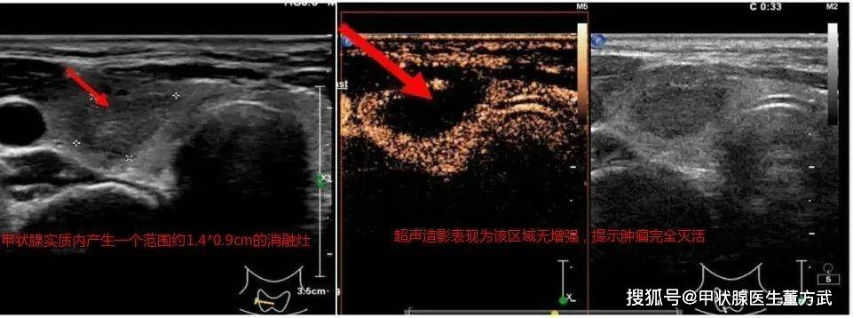 王女士消融第2天超声影像在微波消融技术开展临床运用之前,甲状腺
