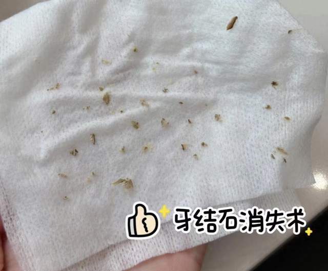 牙齿上的牙结石如何去除?这些方法用好一个,牙石直接成片掉!