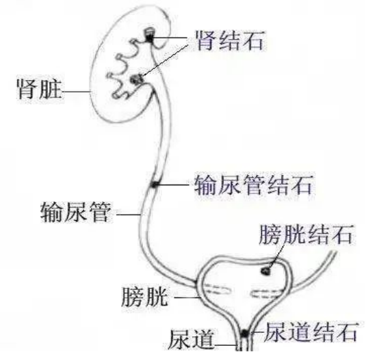 注意了,这几类人群容易被泌尿系结石盯上!
