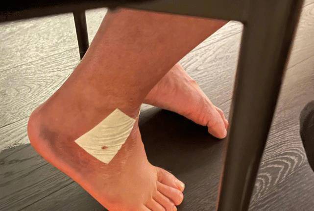 为了给粉丝报平安,邓超和鹿晗都晒了陈赫目前脚伤的照片,脚腕处依然贴