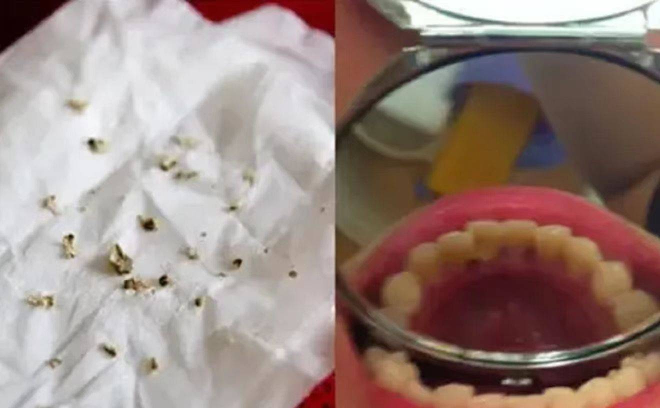 牙结石堆积该怎么去除?教你如何在家就清除牙缝中的"小石头"!