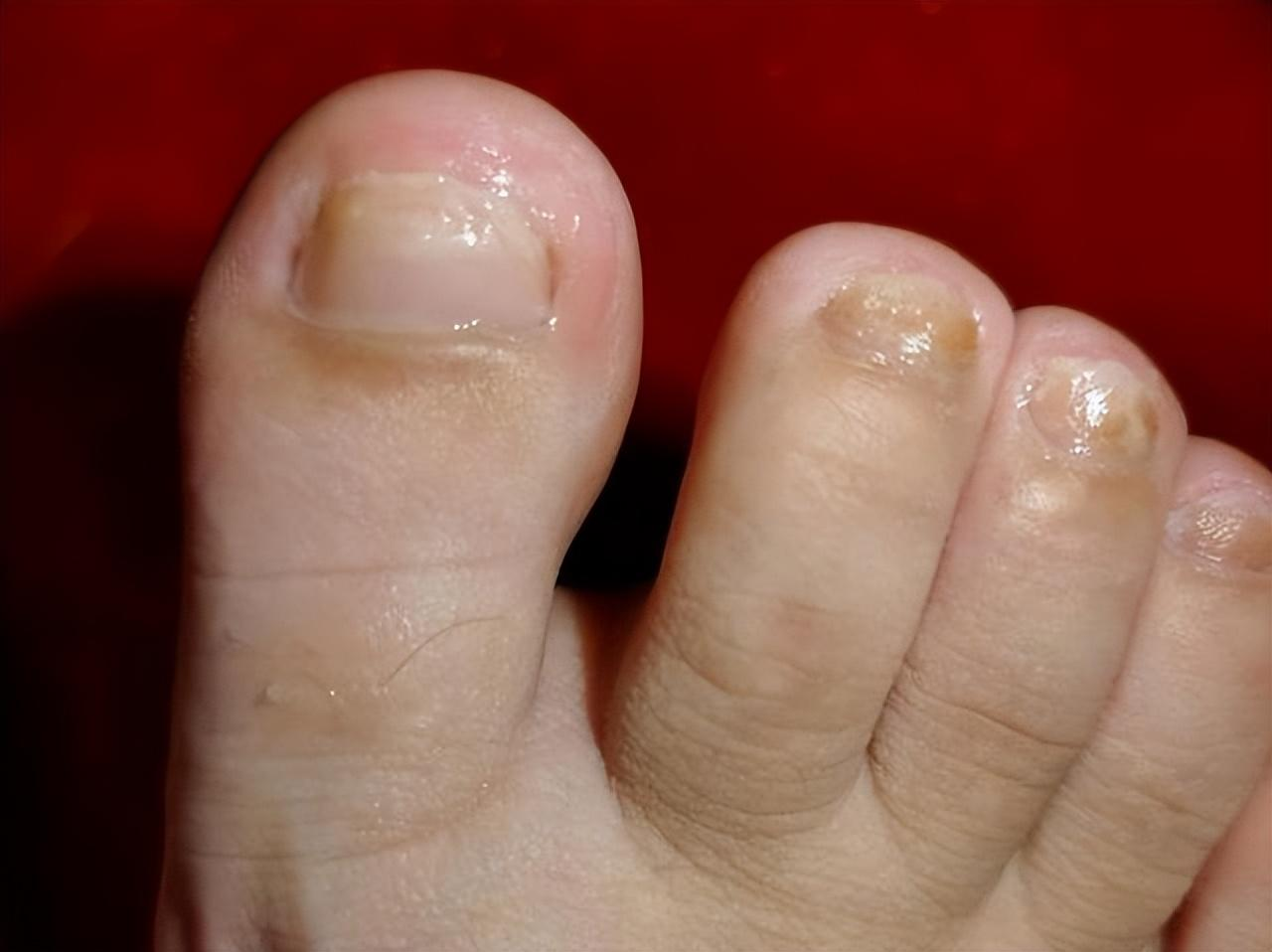 像我的灰指甲比较严重,是用了一个月左右坏甲才无痛脱落的,症状不太