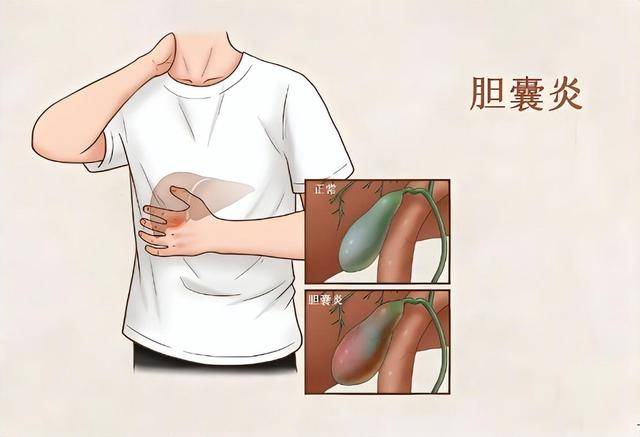 急性胆囊炎,通常由于胆囊内的胆汁淤积,细菌感染或者胆囊管阻塞引起.