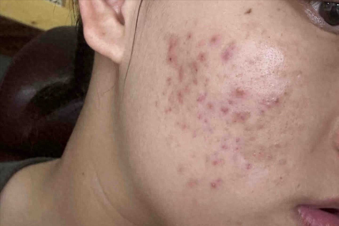 妙招一:用维生素b6控油导致痘痘滋生的主要原因还是油脂过度分泌!