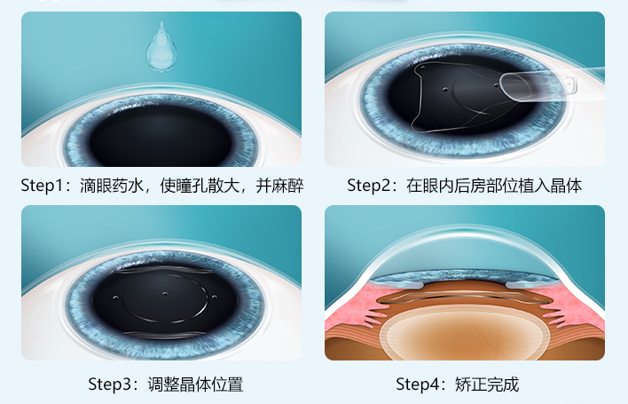 重庆近视手术多少钱?哪种最具性价比?_晶体_激光_价格