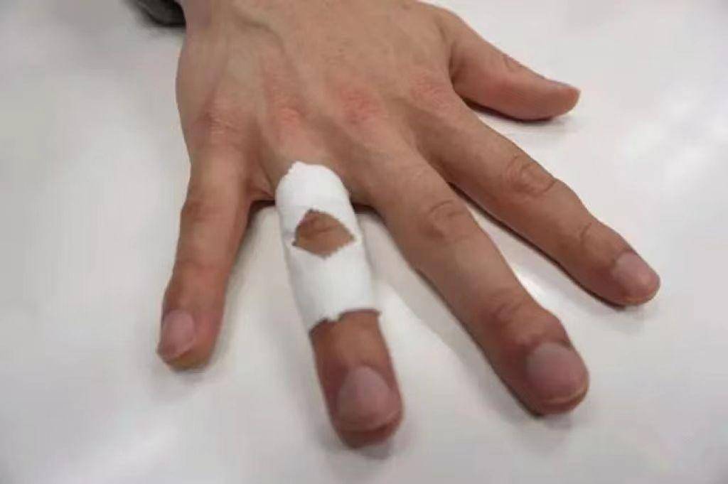 打篮球不小心戳伤了手指怎么办?_关节_运动_受伤