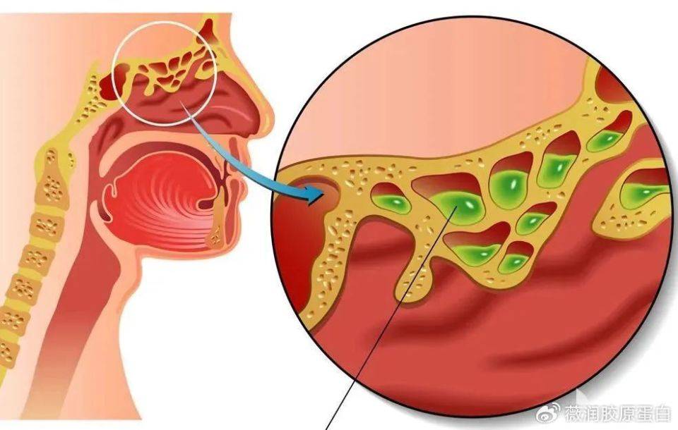 Ⅲ型胶原蛋白修复受损鼻粘膜_鼻腔_治疗_炎症