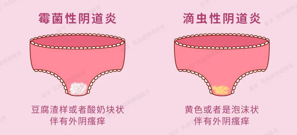 滴虫性阴道炎:主要症状为阴道分泌物增多(白带呈灰黄色或者是泡沫状