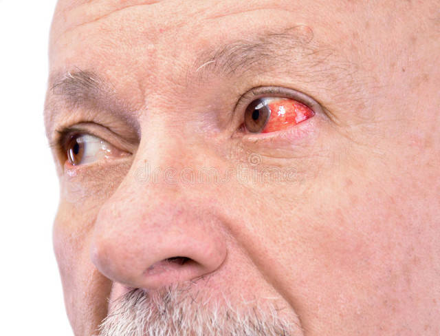 红眼病传染全家连狗眼都红了,网友:真是有祸同当啊_发病_风波_患者