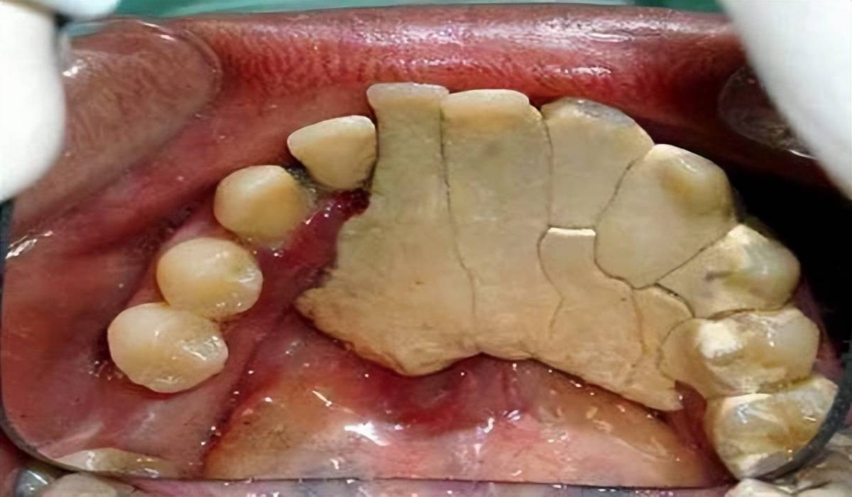 怎么去除牙结石 来自搜狐网