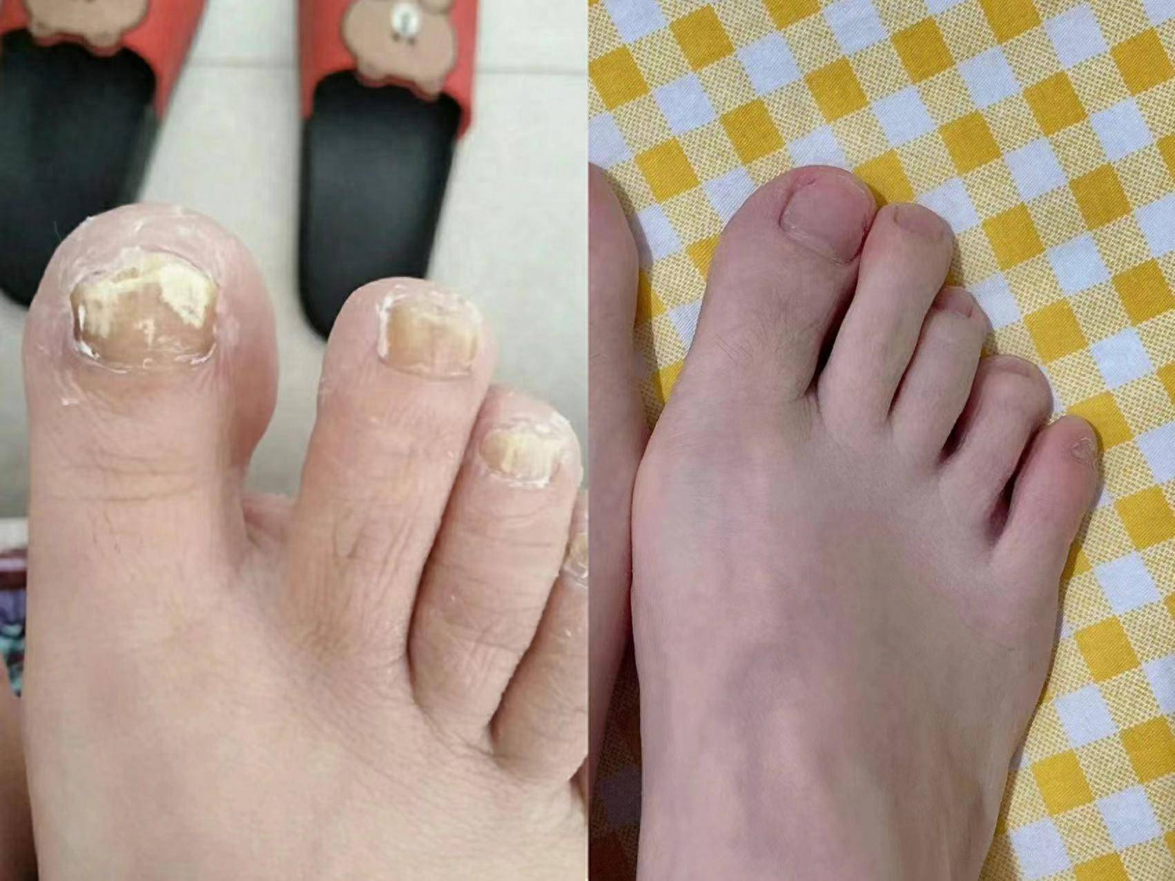 甲zhi灵我用着效果最好的抑菌液必须放在第一个说,它也是我根治灰指甲