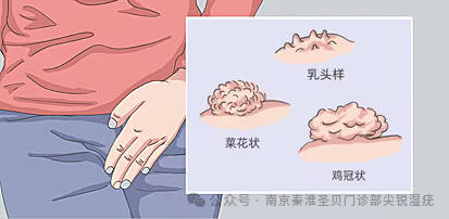 菜花状疣初期图片_检查_治疗_患者