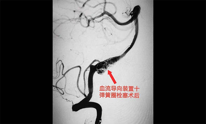 原创女子走路摔倒意外发现多发夹层动脉瘤席刚明教授团队化险为夷