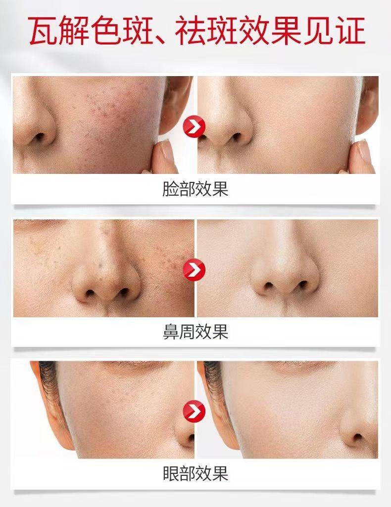 真情实意推荐祛斑效果最好的排名第一