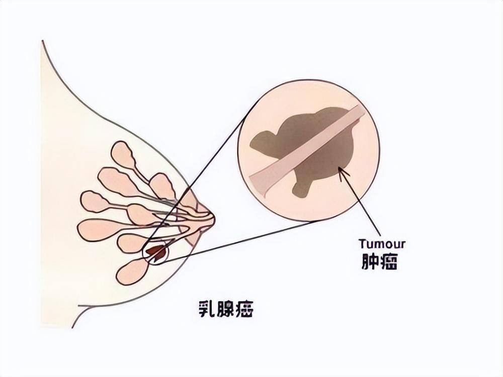 乳腺癌位置图图片