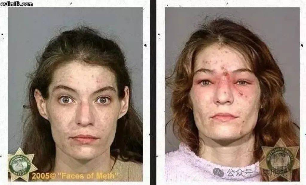 吸毒前后对比图堪称毁容胆小慎入