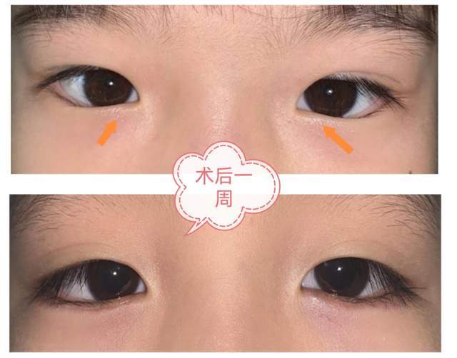 术后一周)(▲ 双下睑内翻倒睫—术后一月)六,不做手术会怎样呢?