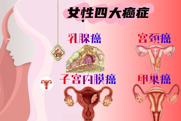 乳腺癌,子宫内膜癌,卵巢癌和宫颈癌是女性常见的恶性肿瘤,长期高雌