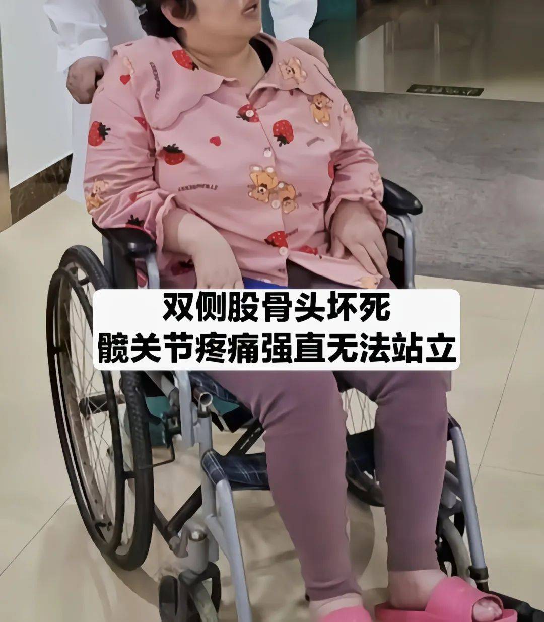 移动医大手术平台〡股骨头坏死卧床整整三年关节置换术后下地仅需三天