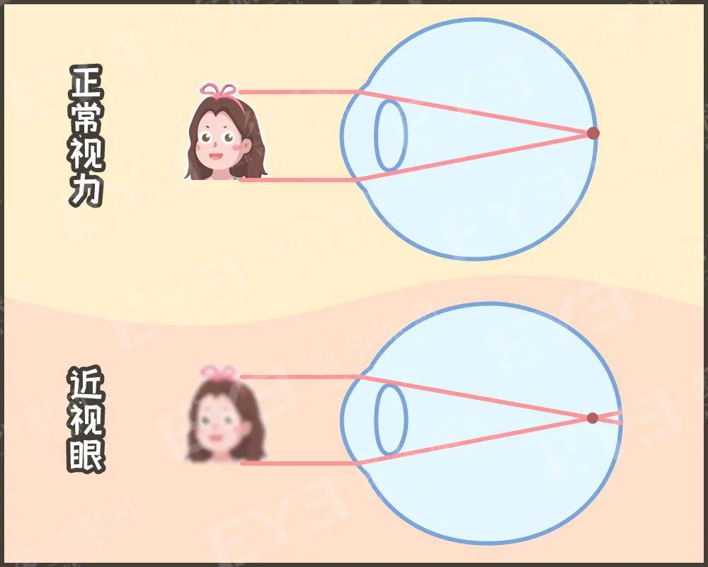 近视眼球突出怎么恢复图片