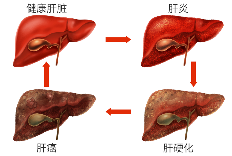 肝硬化离肝癌只有一步之遥!这些行为最伤肝,很多人却不重视