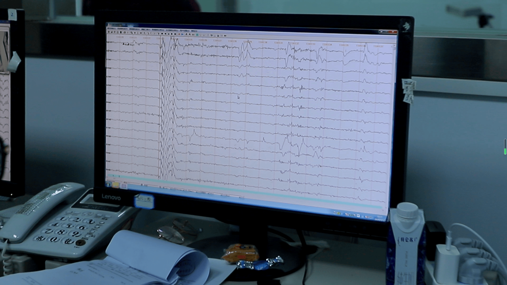 脑电图检查正常图片