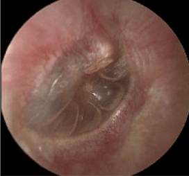 原创医大技术耳鼻咽喉科鼻咽癌放疗后耳朵听不见了