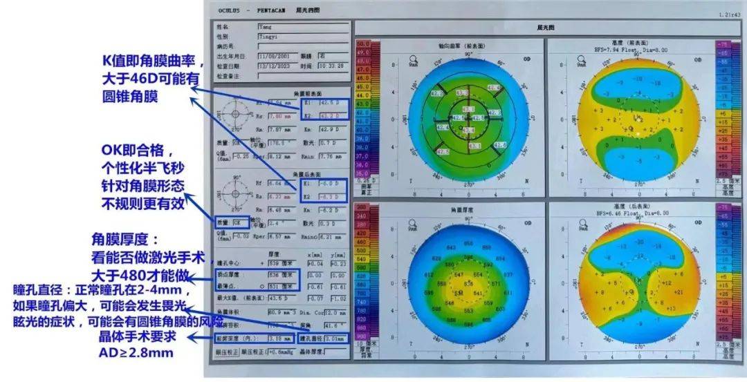 角膜地形图报告单解析图片