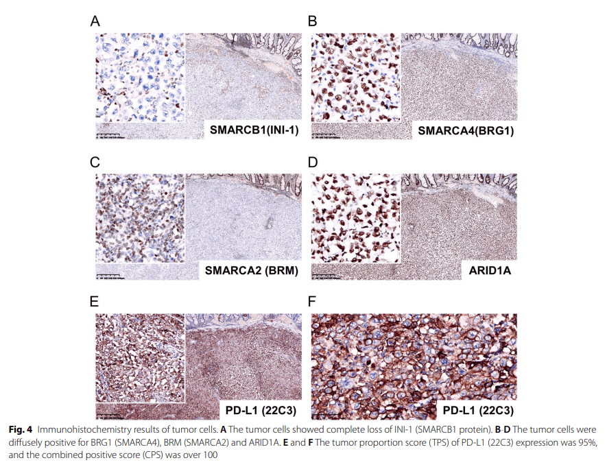 pdl1高表达的smarcb1缺失性未分化直肠癌持续获益替雷利珠单抗