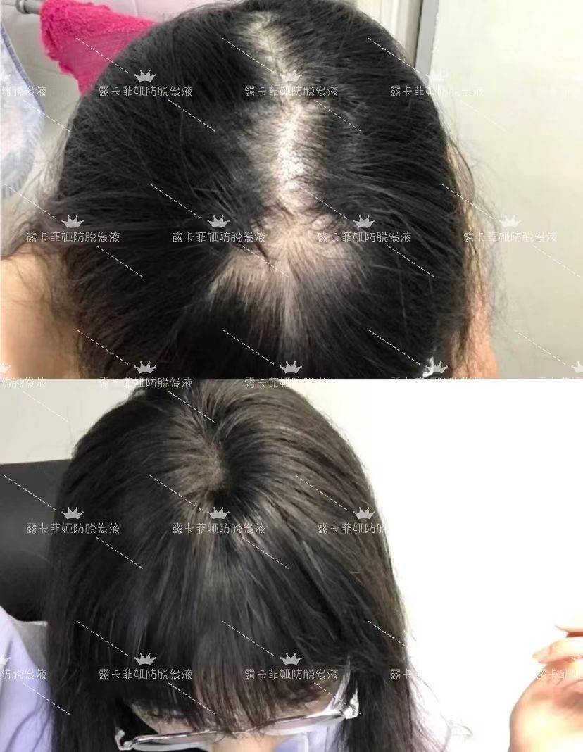 测评,防止脱发的最好方法有哪些,生效关键在成分!_头发_头皮_头顶