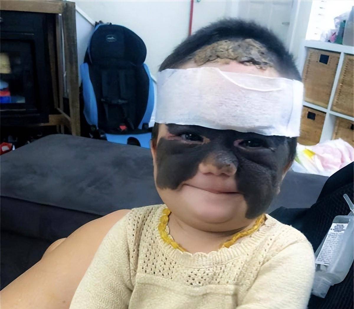原创还记得天生胎记酷似蝙蝠侠的女婴吗6次整容后仍在治疗