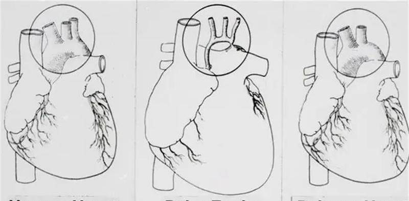 原创84年的一场惊世骇俗的手术产生人身狒心女婴最终情况如何