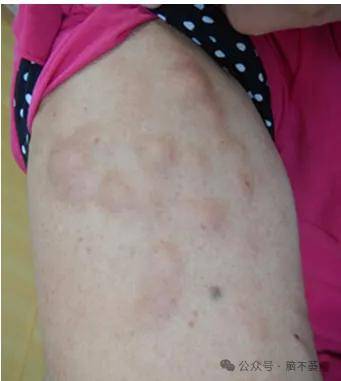 儿童局限性硬皮病几年能治好