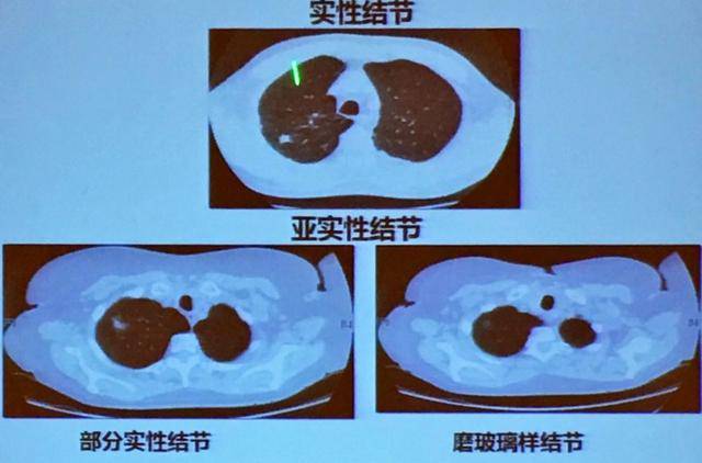 查出肺结节不能吃大虾吗