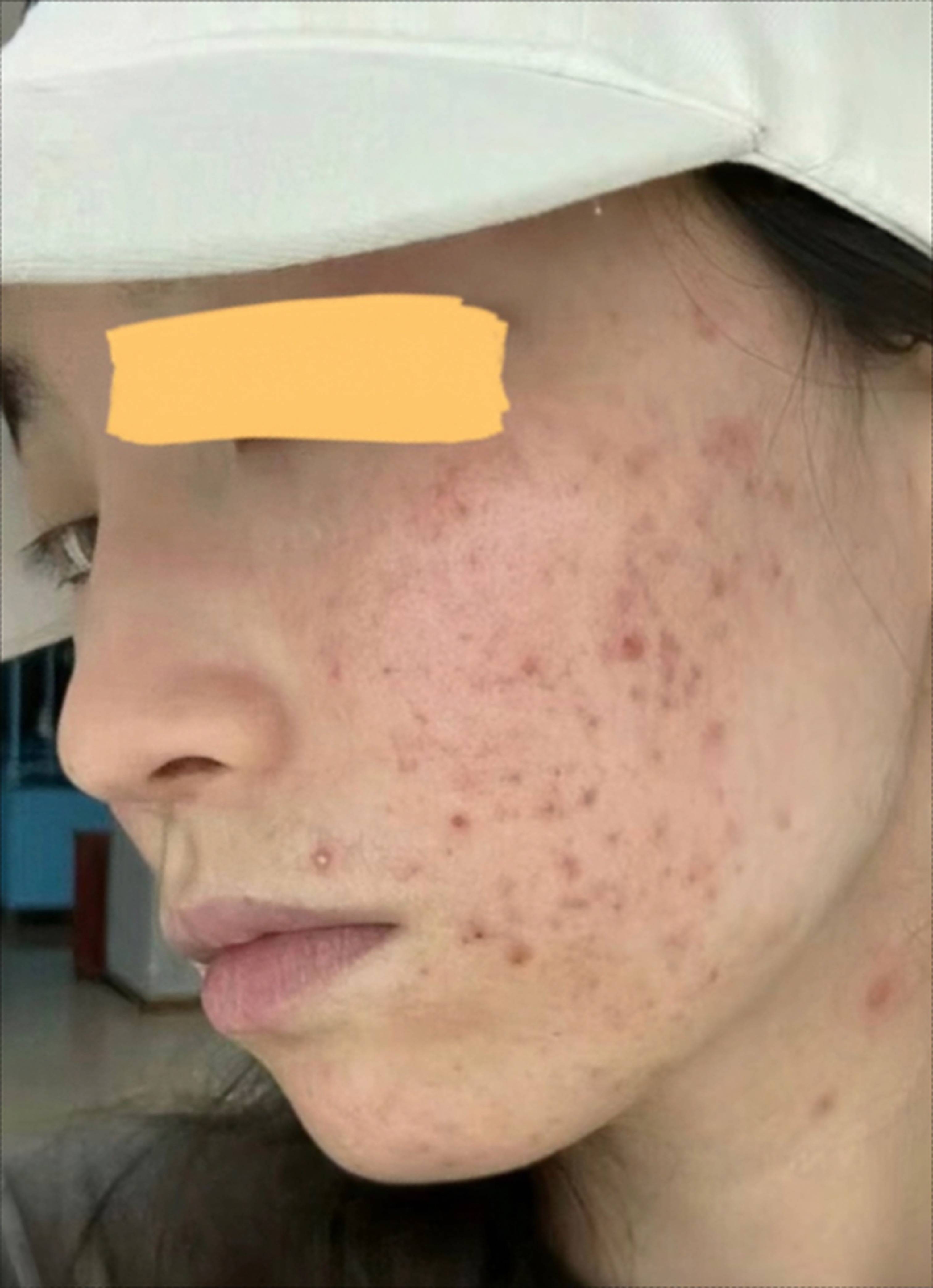 不服不行芦荟胶+它祛除痘印真的太绝了不看吃大亏