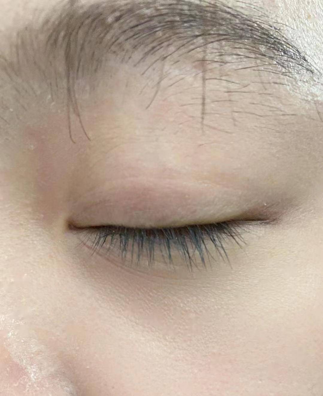 双眼皮出现疤痕增生,到底该怎么正确修复?