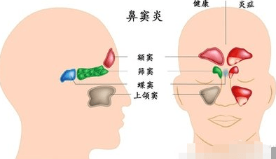 正常鼻子与鼻炎图片图片