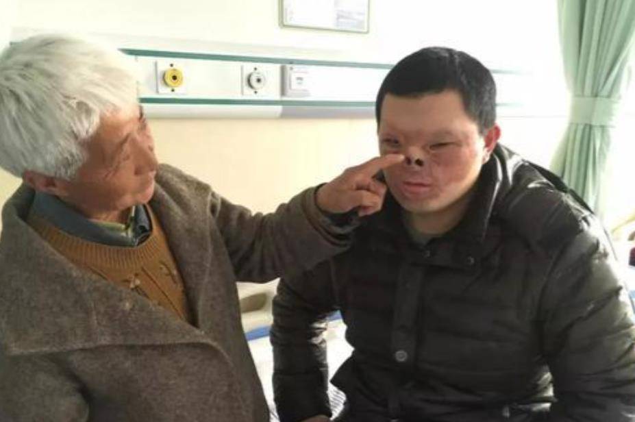 原创湖北小伙被烧伤严重毁容7次整形手术后记录下人生第一张自拍
