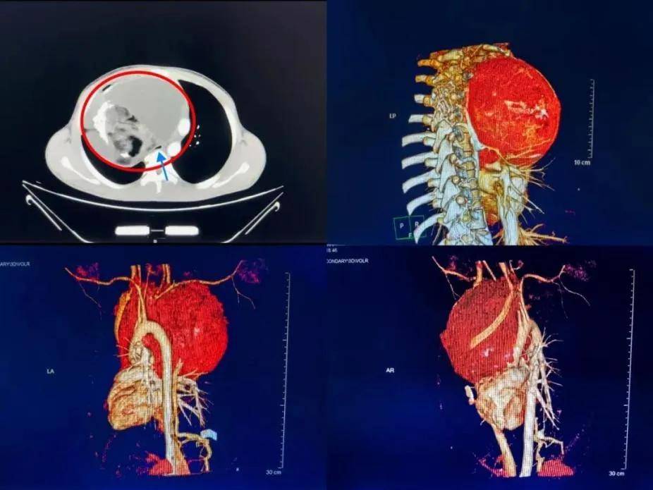 切除肿瘤17岁少年重获新生