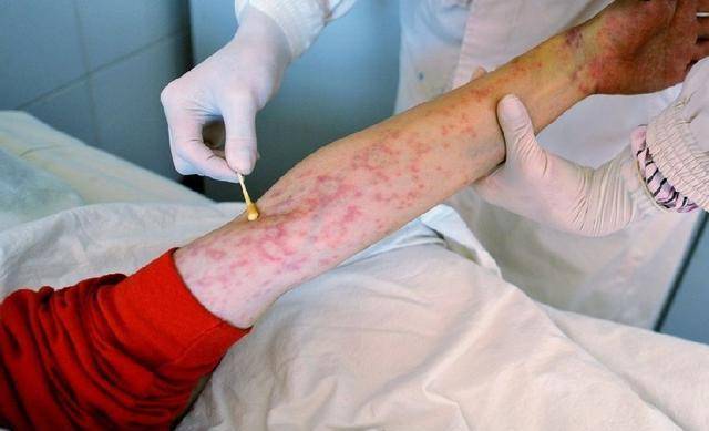 原创16年前还是大二学生的她被非洲男友感染艾滋病如今怎么样了