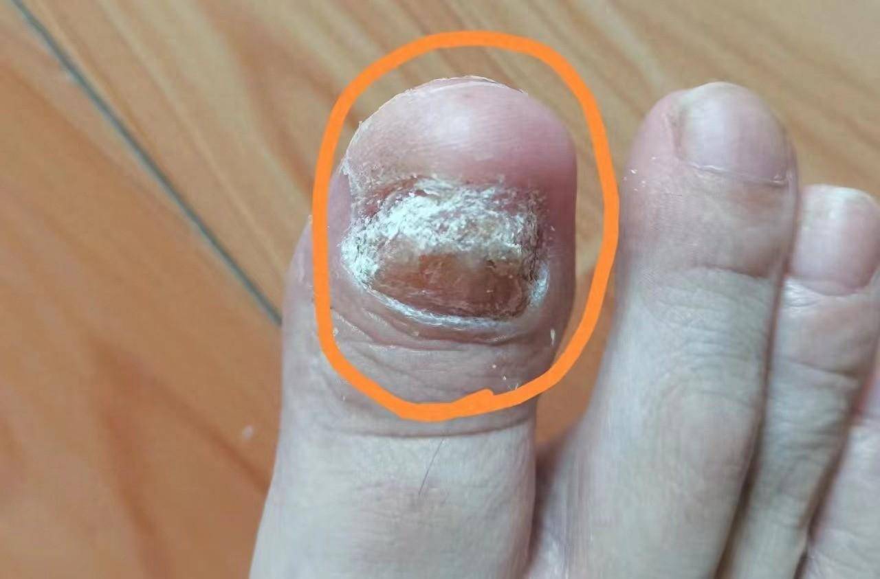 指甲发黄暗沉灰指甲重度患者分享自用疗法30天告别灰指甲
