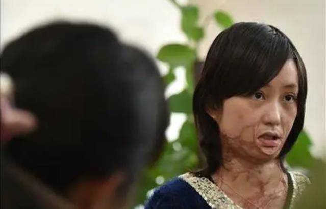 原创安徽16岁少女周岩因拒绝官二代追求被泼汽油毁容如今怎样