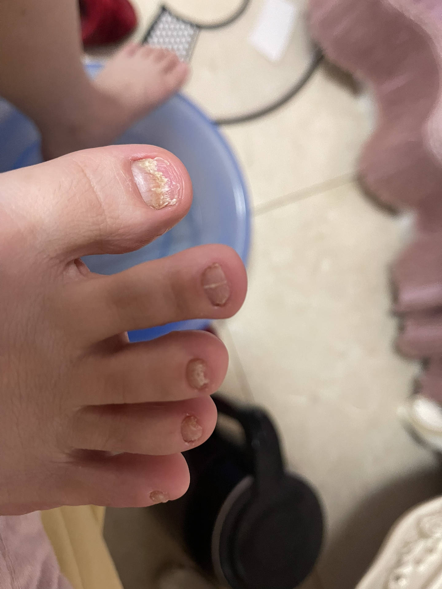 还在觉得灰指甲顽固难治这些祛灰方法你到底用了没