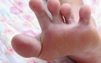 控制_治疗_芦丁