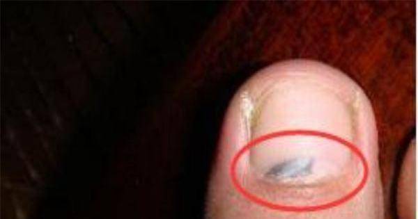 当指甲出现斑点时身体发生了什么变化